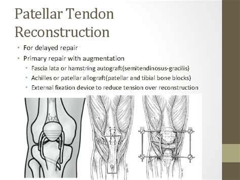 Patellar Tendon Rupture Repair