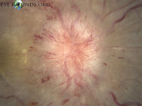 Atlas Entry Idiopathic Intracranial Hypertension Iih