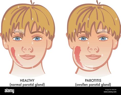 Parotid Gland Parotitis