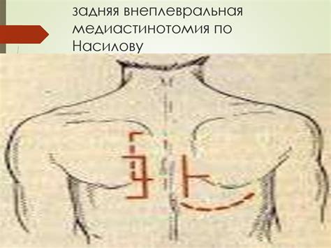 Острый медиастенит - презентация онлайн