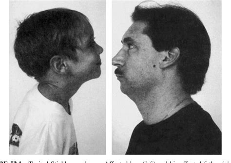 Figure 521 From The Stickler Syndrome Semantic Scholar