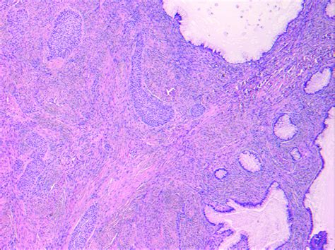 Radiographic Features Of A Benign Mixed Brenner Tumor And Mucinous