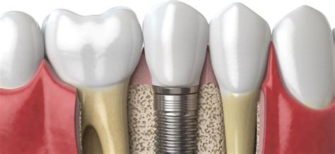 How Much Does a Dental Implant Cost? | Mint Hill Dentistry