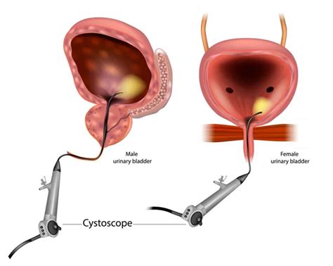 Diagrama Que Muestra Una Cistoscopia Flexible Para Un Hombre Y Una