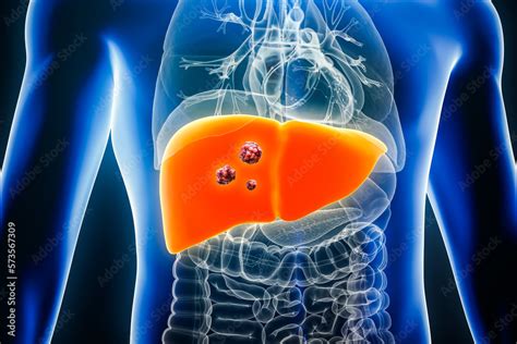 Liver Cancer With Organs And Tumors Or Cancerous Cells 3d Rendering Illustration Anatomy