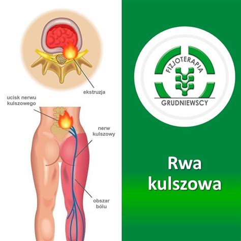 Fizjoterapia Grudniewscy Co To Jest Rwa Kulszowa Jakie S Jej