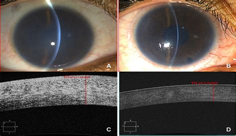 Descemet Membrane Endothelial Keratoplasty In Congenital Her Cornea