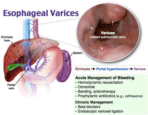 Banded Esophageal Varices