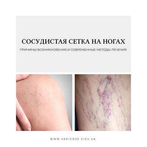 видно вены на ногах чем убрать