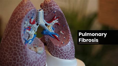 Stages Of Pulmonary Fibrosis