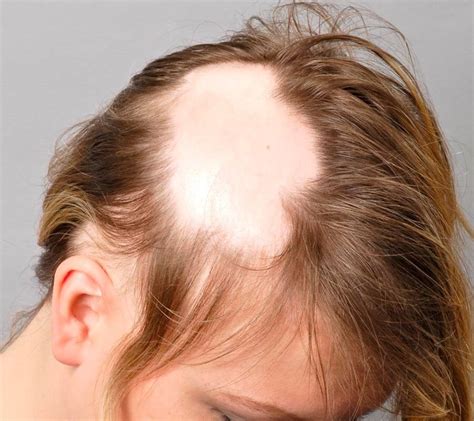 Entendendo a Queda de Cabelo Causas prevenções e tratamentos