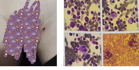 Clinical Features of Severe Tsutsugamushi Disease Complicated with Hemophagocytic ...