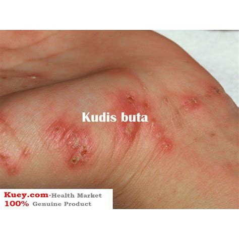 Ubat Kudis Buta Kutu Kepala Scaboma Lotion For Scabies Kudis Buta Kutu