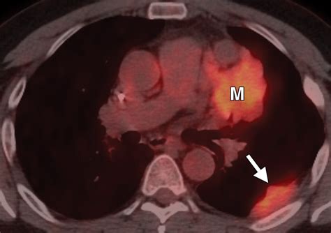 Role Of Imaging In The Diagnosis Staging And Treatment Of Thymoma