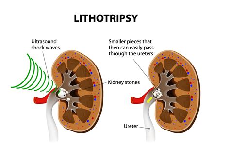 Lithotripsy | AUA Surgical Center