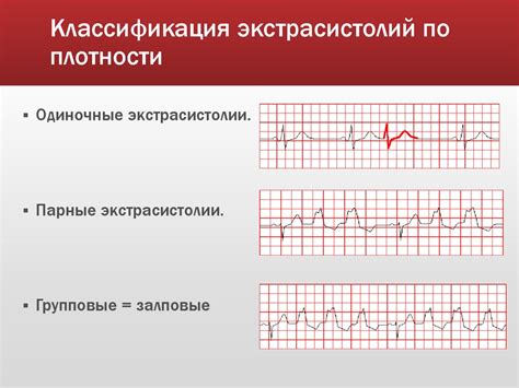 Экстрасистолии - презентация онлайн
