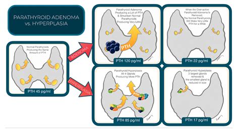 Parathyroid Hyperplasia Vs Adenoma Dr Larian