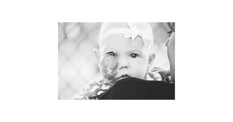 Baby With Capillary Hemangioma on Her Face | POPSUGAR Family Photo 20