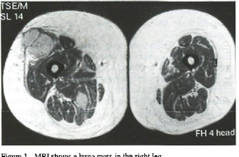 Figure From Skeletal Muscle Metastases From Renal Cell Carcinoma A