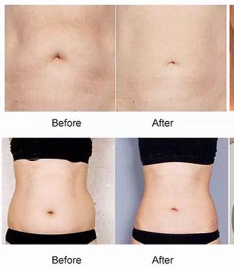 Liposonix Treatment HIFU Slimming