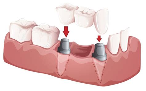 Implant Supported Bridge Ridgewood Nj Bergen County Nj