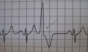 Premature Ventricular Contraction Ecg