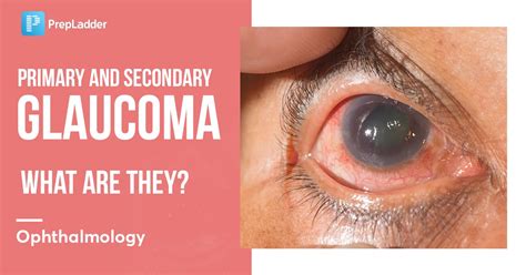 Primary And Secondary Glaucoma What Are They