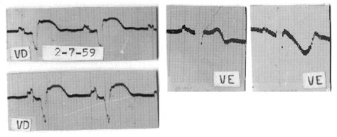 Infarct Combat Project - ECG Vectorial Theory