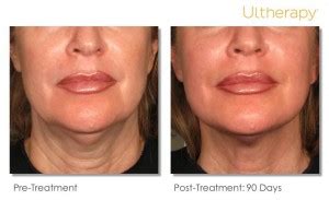 Be Uplifted With Ultherapy Skin Care Institute Tulsa OK