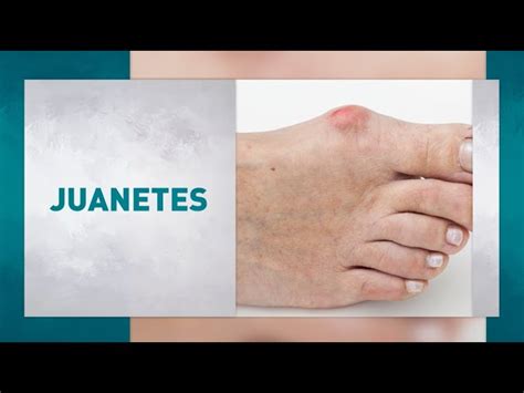 Tratamiento de juanetes en los pies cómo aliviar el dolor y prevenir