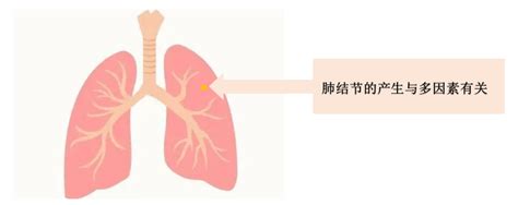 健康科普｜正确认识肺结节进行复查治疗