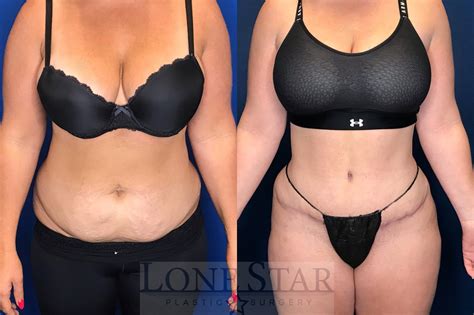 Tummy Tuck Before And After