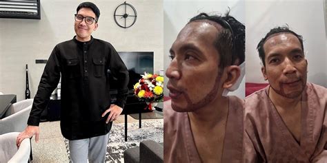 7 Potret Desta Jalani Transplantasi Rambut Dan Jenggot Jambang Mulai