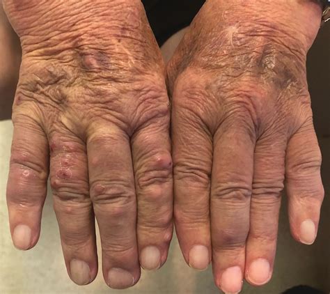 Rheumatoid Arthritis Nodules