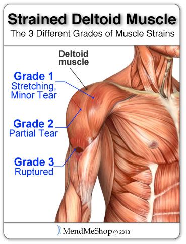 Deltoid muscle pain and the causes