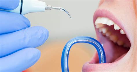 Sarro Dental Causas Consecuencias Y C Mo Prevenirlo