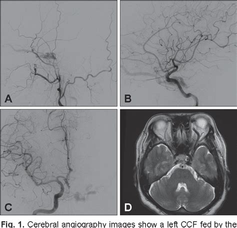 Figure 1 From Spontaneous Carotid Cavernous Fistula In A Case With