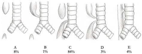 Tracheoesophageal Fistula Classification