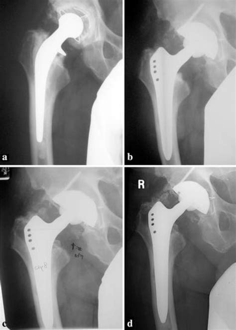 Ap Pre Revision Radiograph B Post Operative Radiograph Of Revision Download Scientific Diagram