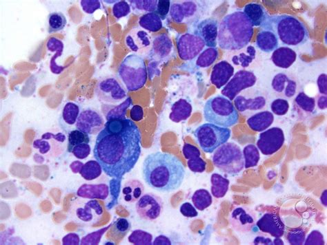 Plasma cell myeloma - Russell bodies