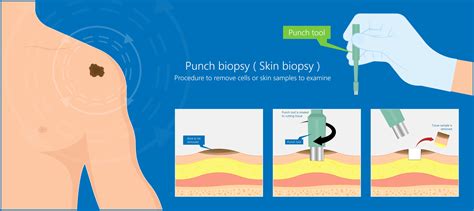 Punch Biopsy Of Skin