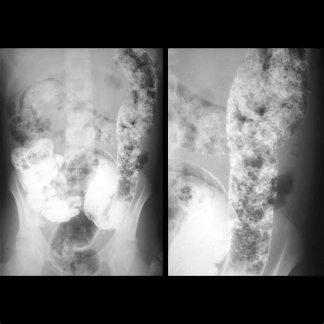 Pediatric Ulcerative Colitis Pediatric Radiology Reference Article