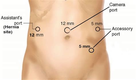 Trocar Site Herniation Tsh Of The Small Bowel Following Laparoscopy