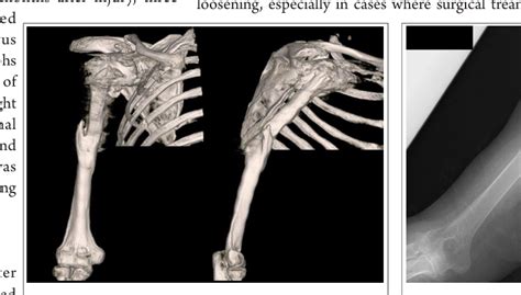 Figure 3 From Treatment Of Humeral Fracture After Shoulder Arthroplasty