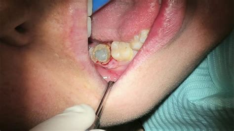 Pus From Infected Wisdom Tooth Youtube