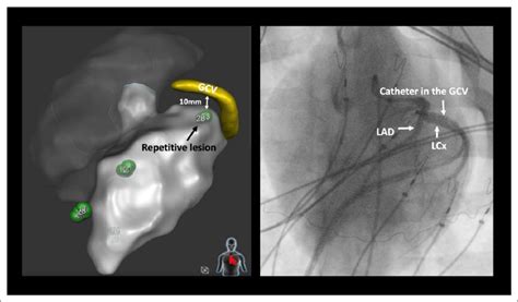 The Effect Of Pulsed Field Ablationon Endocardial Ablation Close To