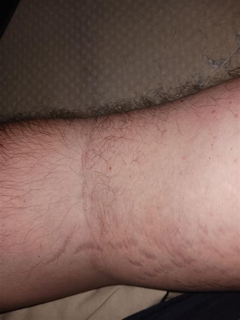 Are These Cushions Stretchmarks And A Moon Face Rcushings