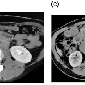 Approach To CT Guided Biopsy Of Retroperitoneal Lesions A A Case