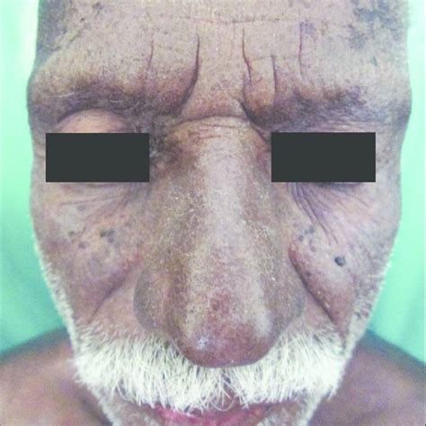 Hyperpigmentation over the face | Download Scientific Diagram