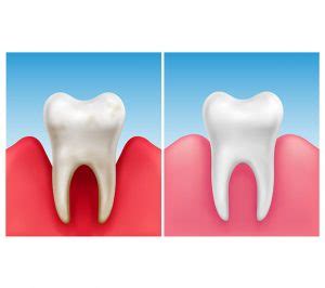 Comprehensive Periodontal Treatment Eastbayimplant